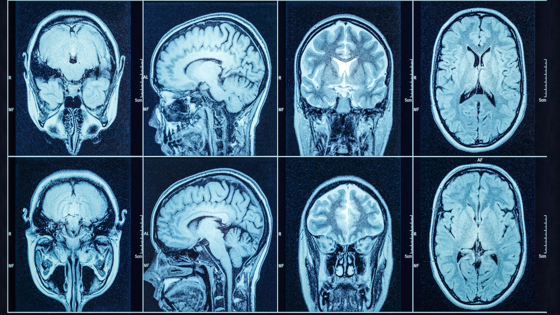 eight panels showing scans of a person's brain from different angles