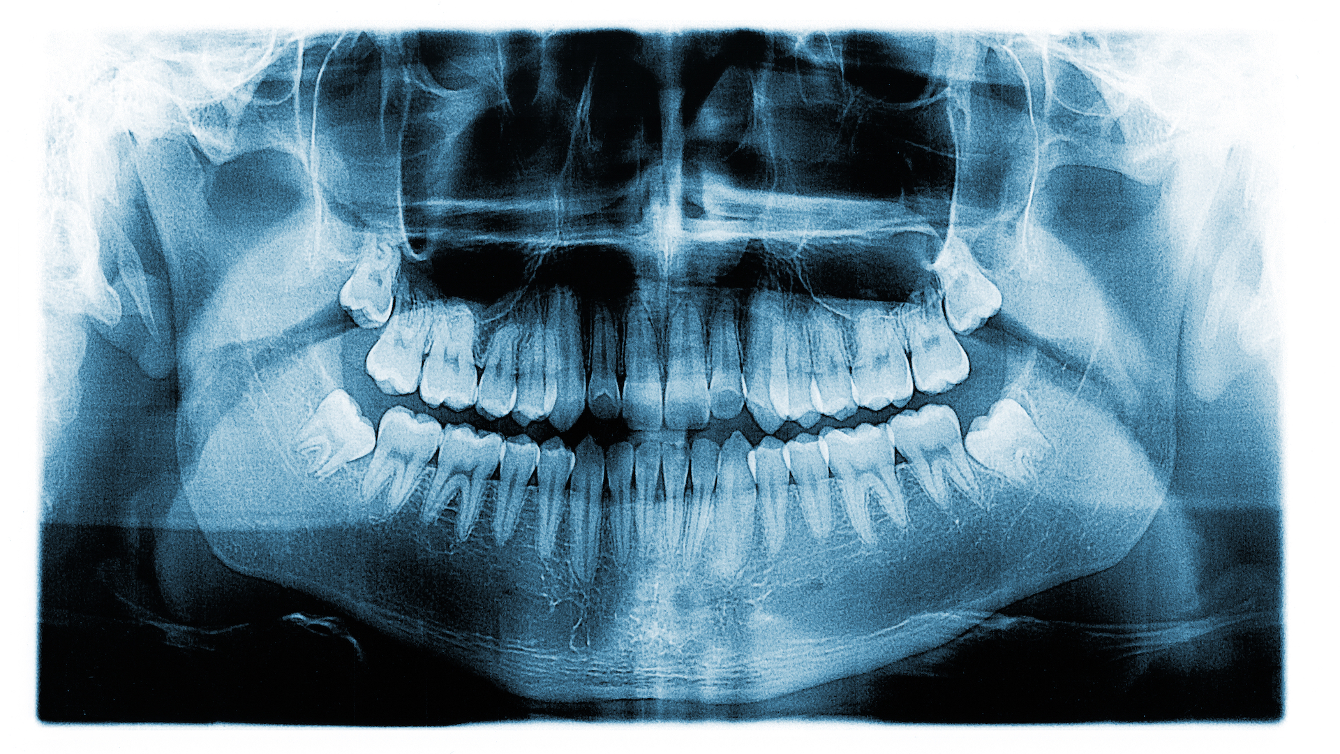 An x-ray of a mouth full of teeth