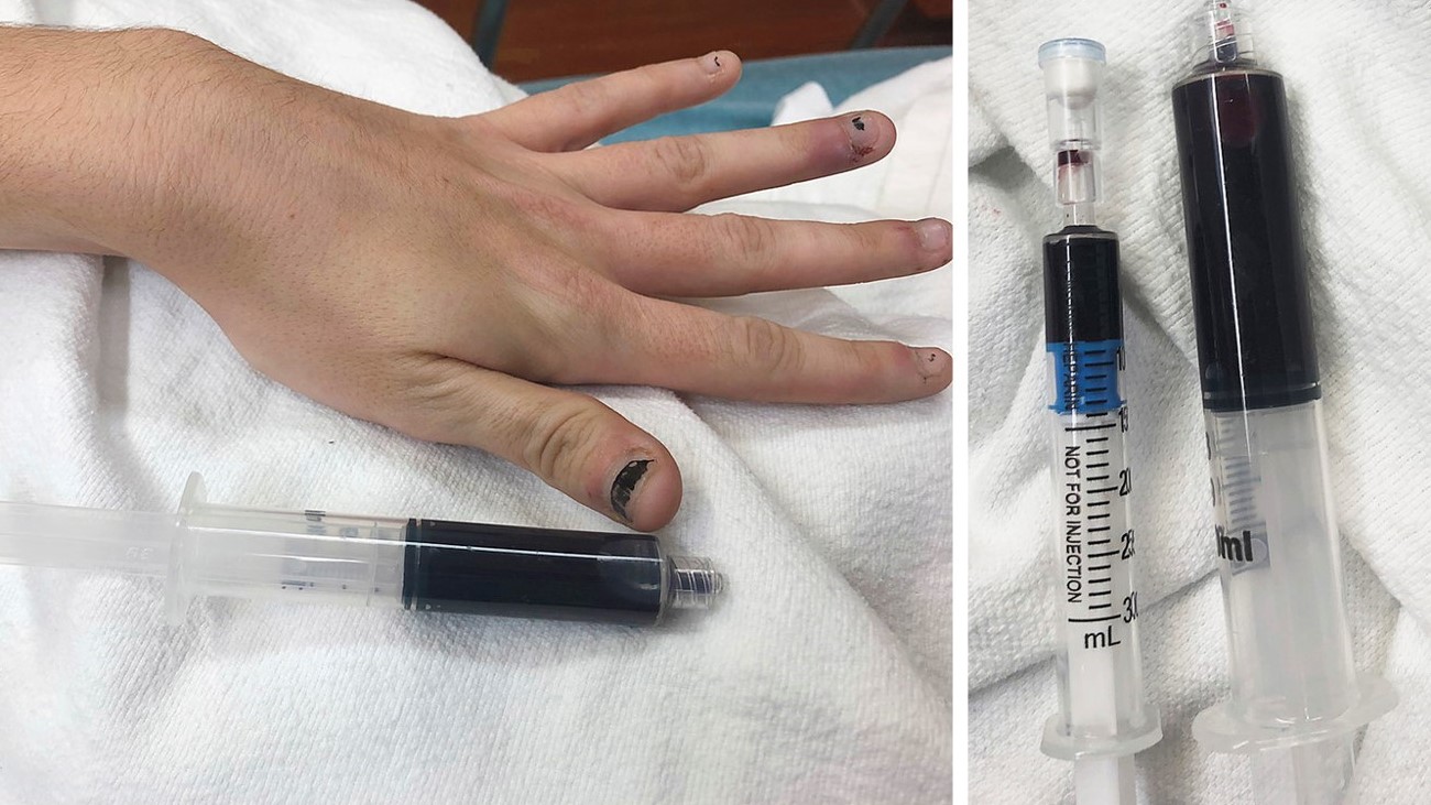 Two photos; the left photo shows a woman's hand with dark blue nails and a syringe of dark blue blood. The right shows two syringes of dark blue blood.