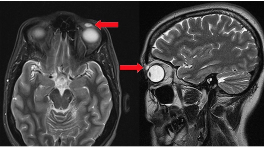 Two brain scans show a woman's head from different angles. Red arrows indicate the location of a small cyst in her eyelid