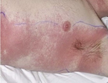 A photo of a white man's armpit, featuring a bright pink skin rash