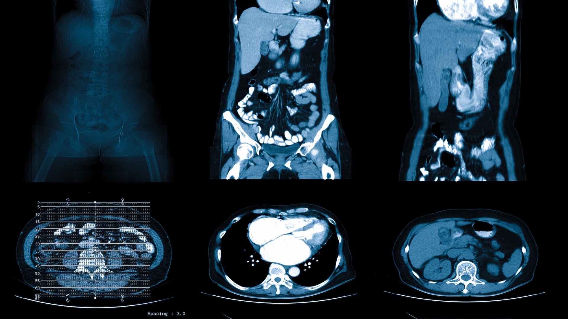 three CT scans of an abdomen next to each other