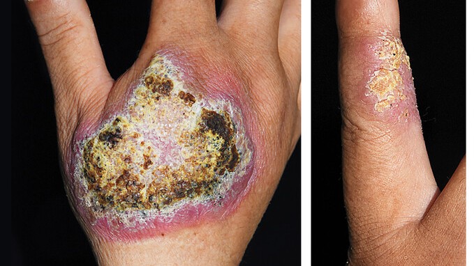 On the left-hand-side of the image is a close-up of the yellow-brown wart growing on the man's right hand. On the right-hand side of the image is a close-up of the crusty wart developing on his right index finger.