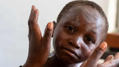 Reuters Medication applied to the face of a child with mpox - an infectious disease leading to a painful rash - at a health centre in Munigi, Nyiragongo territory, near Goma in North Kivu province of the Democratic Republic of Congo.