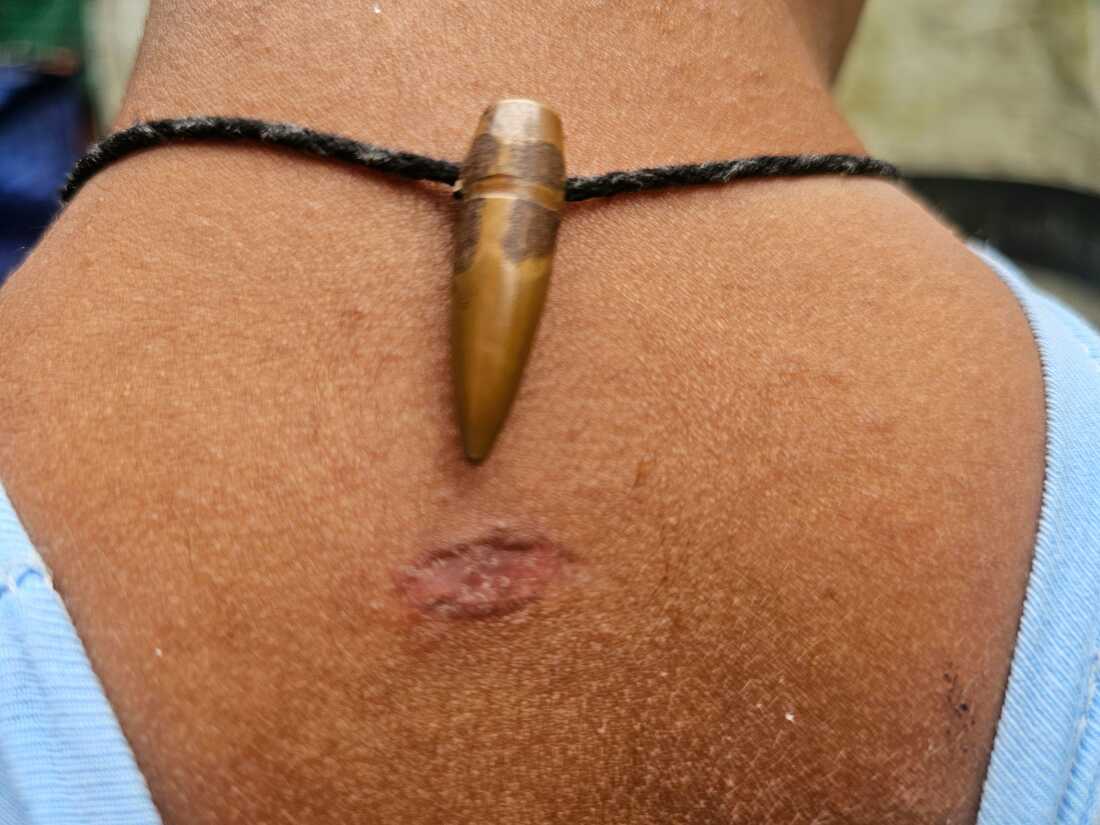 Noman, a Rohingya boy who is 7 years old, shows the bullet that wounded him a month ago during clashes between the rebel Arakan Army and government forces. Naman and his family fled to the Rohingya refugee camp in Cox's Bazar, Bangladesh.