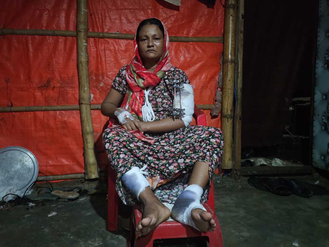 Humaira 34, a Rohingya woman, mother of 5 under 18 children, injured in a drone attack of Arakan Army (AA) targeting a home on 4th Aug in Maungdaw town, Arakan State, Myanmar. Humaira suffered a huge trauma and was seriously injured on her arm and legs. Three more of her family members were also injured in the same incident. Hamaira and other injured victims fled to Bangladesh in search of safety. Humaira received first batch of emergency treatment from @doctorswithoutborders in Kutopalong and seeking support for the special treatment to recover her wounds faster.