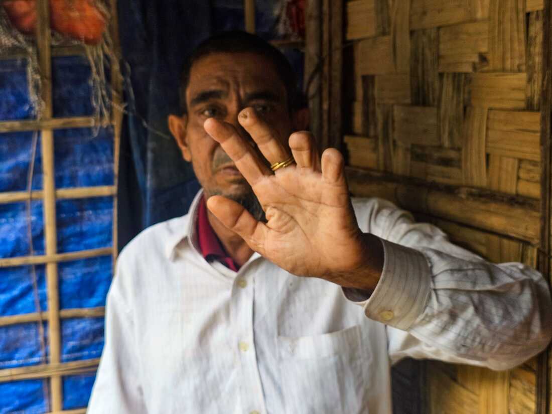 Arakan Army (AA) cut three fingers of an elderly Rohingya man in Maungdaw, Arakan State, Myanmar. Badi Alom 62, an already vulnerable Rohingya man was detained by Arakan Army (AA) when he went to a Barzar to buy fishes for family three months ago. He was tortured day and night in the detaintion of AA. His fingers were cut mercilessly during the interrogation. Alom's family fled to Bangladesh due to the intense fighting of Arakan Army (AA) and Military in Maungdaw in Aug, 2024. Alom reunited with his family in a Rohingya Refugee Camp in Bangladesh after he was released from the detaintion of Arakan Army.