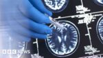 Donanemab: NHS won’t fund new drug to gradual Alzheimer’s