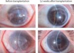 Stem-cell implants restore imaginative and prescient in sufferers with corneal stem cell deficiency